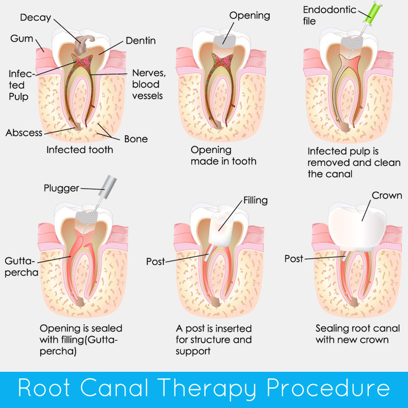 root canal procedure